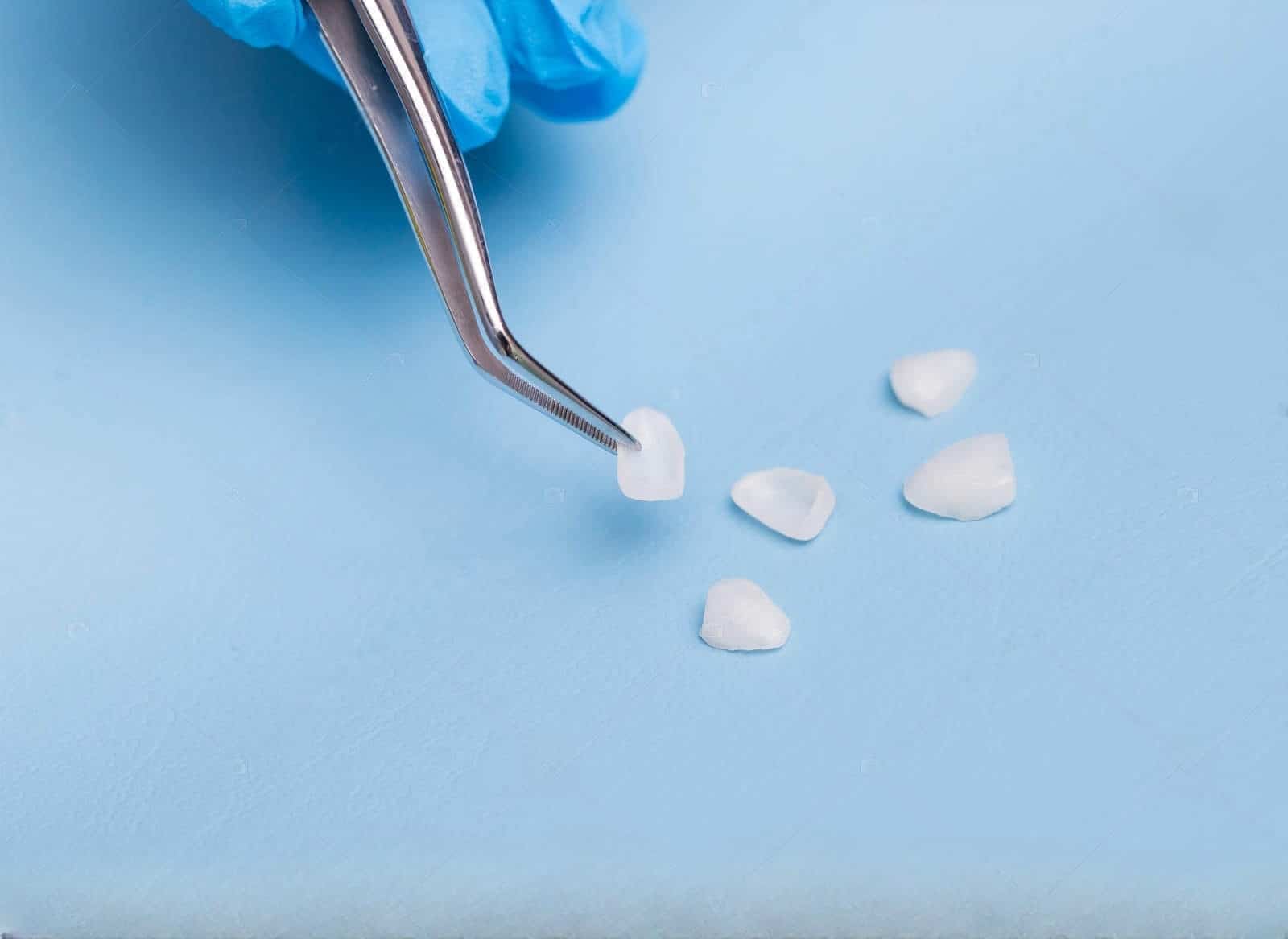 Ceramic Veneers in Sapin