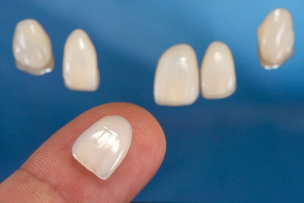Composite Veneers in Sapin