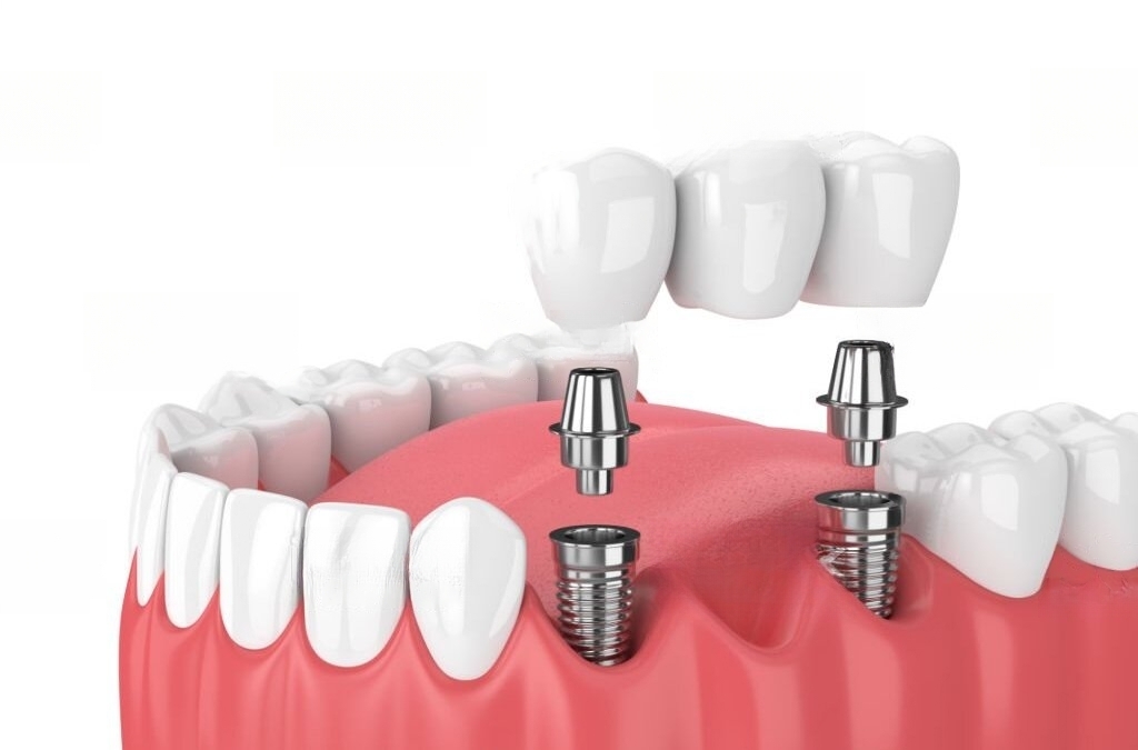 Dental implants in Spain bridge implants