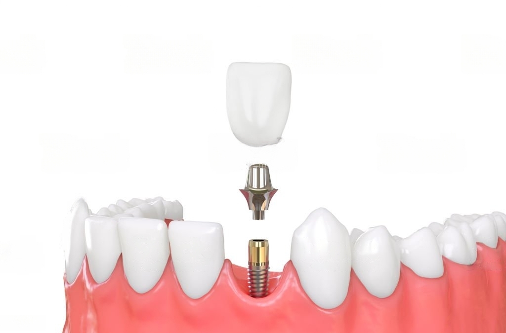 Dental implant in Spain  